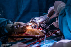 In accordance with the morning’s surgical schedule, we head to the operating room at around 10 a.m.: Dr. István Hartyánszky is implanting an artificial heart into a male patient’s chest - his 100th at the time of our report. During the nearly five-hour procedure, the artificial heart, measuring barely 10 centimeters, is implanted next to the patient’s heart: In the device weighing roughly 500 grams, a miniature pump replaces the function of the left ventricle, circulating the blood. An average of 10-12 such procedures are carried out annually at the Városmajor Heart and Vascular Center. It is here that the first artificial heart implantation in Hungary was performed on February 15, 2008, and that a patient received the first permanent artificial heart in Hungary on September 20, 2012.