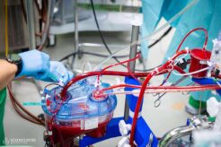 During surgery, various medications (e.g., to regulate blood pressure) can also be administered to the patient through the heart-lung machine.