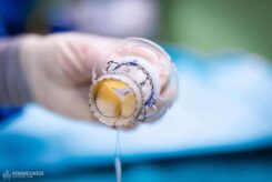 This is what an artificial aortic valve looks like before implantation.