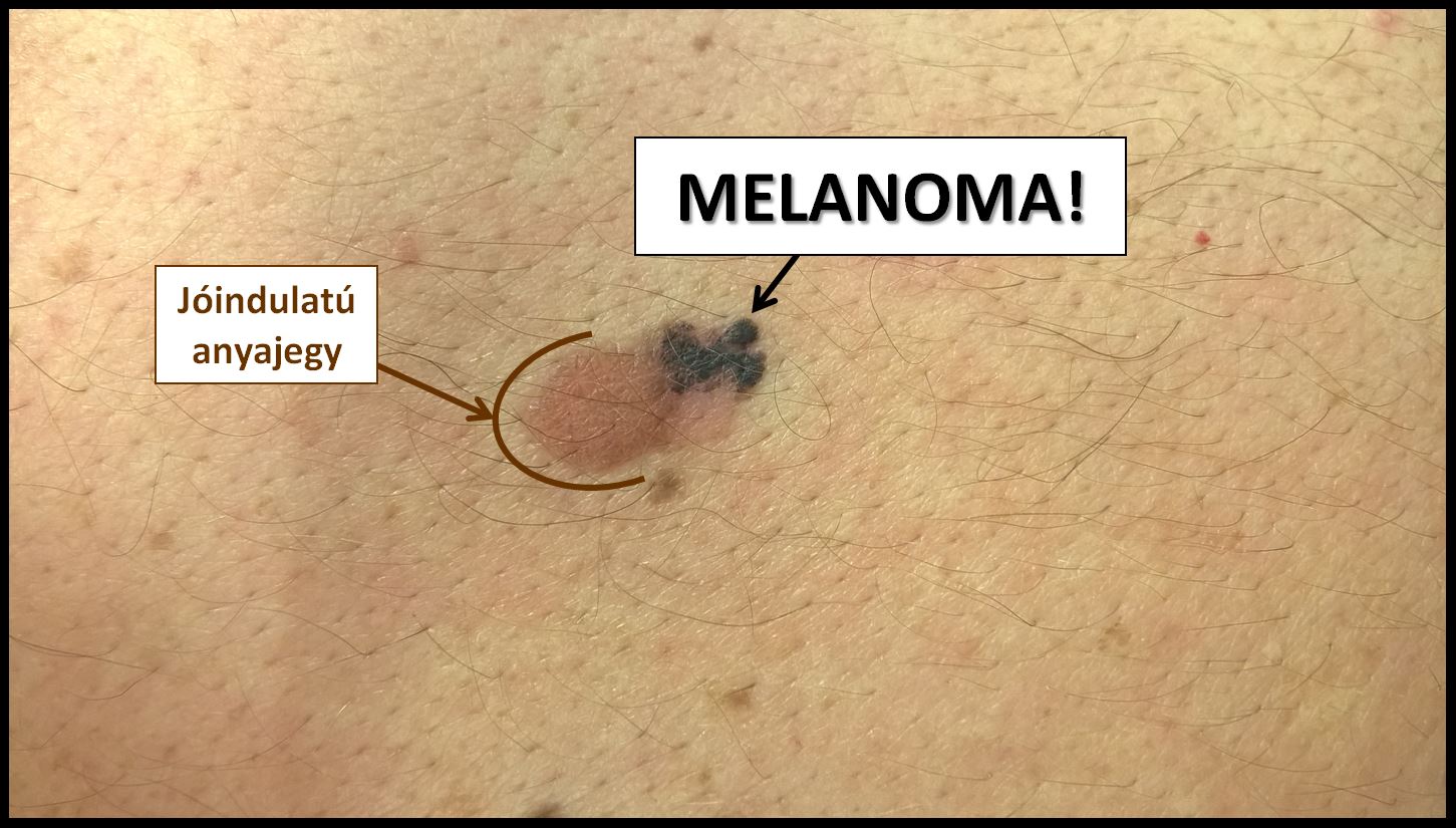 melanoma szövettani gyanúja miatt glaukómával myopia vagy hyperopia alakul ki