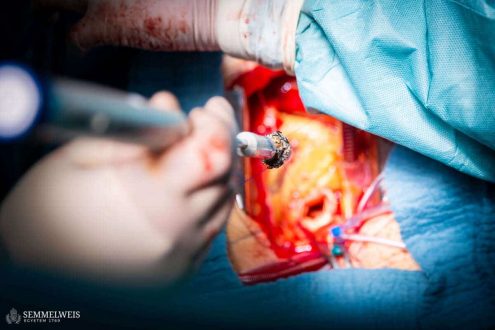 A képen a mesterséges aortabillentyű látható beültetés közben.