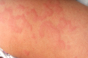 Allergy-urticaria