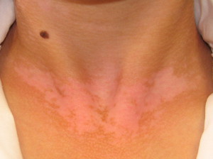 Nap stresszelte bőr | TermészetGyógyász Magazin